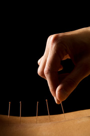 Acupuncture Acupuncture