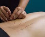 dry needling