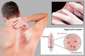 dry-needling 2